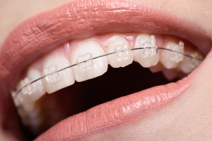 gerade Zähne mit durchsichtige Zahnregulierung und Keramikbracket