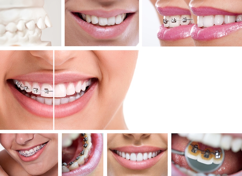 Alternativen Regulierung Zähne